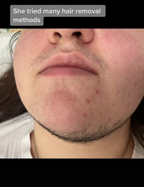 Empowering Laser Hair Removal for PCOS Patients