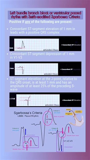 Understanding Modified Sgarbossa Criteria in LBBB/Paced Rhythms 📊❤️ #Cardiology #ECG #SgarbossaCriteria #MedicalResearch #collaboration #Healthcare | Abdallah Othman