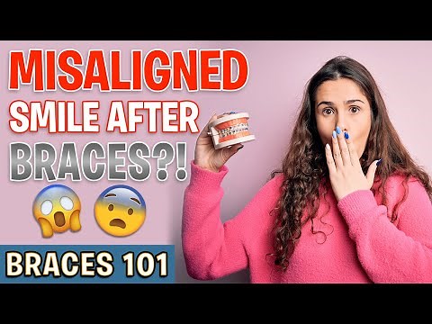 BRACES 101: Misaligned Smile After Braces?! | Treatment Minute Talk!
