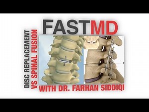 FASTMD Disk Replacement VS Spinal Fusion