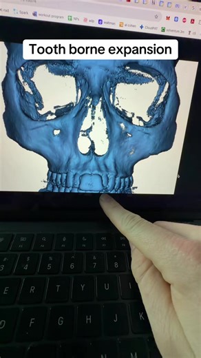 Tooth-Borne RPE for Palatal Expansion Success