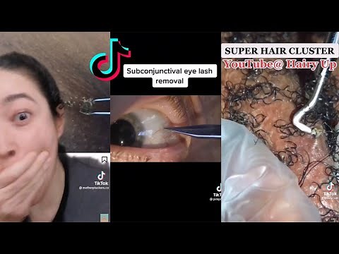 INGROWN HAIR REMOVAL COMPILATION
