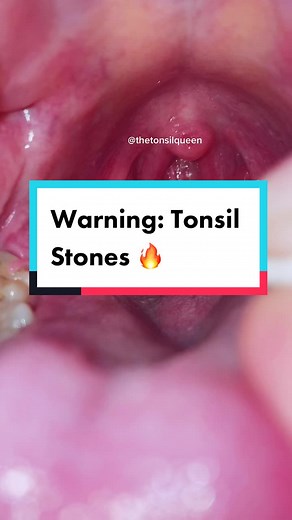 😱😱😱#cw #warning #tonsilstones #popit #tonsillstone #removal #satisfyingvideo #ew #mouth #teeth #pimple #fypシ #asmr #fypage #tonsils #satisfy #gross