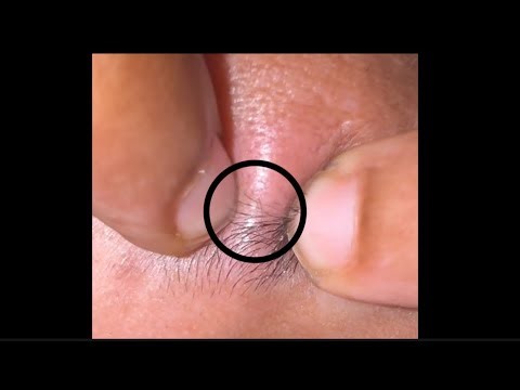 EYEBROW SATISFYING PIMPLE POP