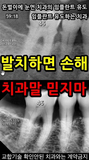 Loss from tooth extraction. Overtreatment involving careless implant procedures. Extraction stand...