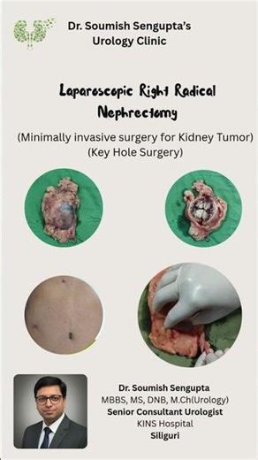 Laparoscopic Radical Nephrectomy | Faster recovery, home in 72 hours