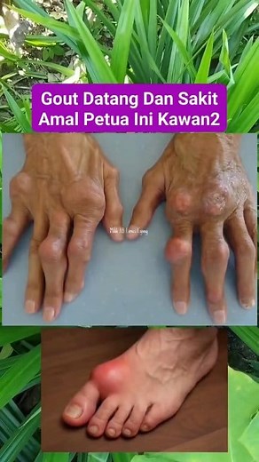 Bila asam urat mula menyerang, orang lama ada caranya tersendiri untuk meredakan rasa tidak selesa. Petua ini bukan pengganti rawatan, tapi boleh jadi ikhtiar ringan untuk bantu tubuh rasa lebih lega ya kawan2 #PetuaOrangLama #RedakanAsamUrat #FypMalaysia #ReelsViral | Linus Eging