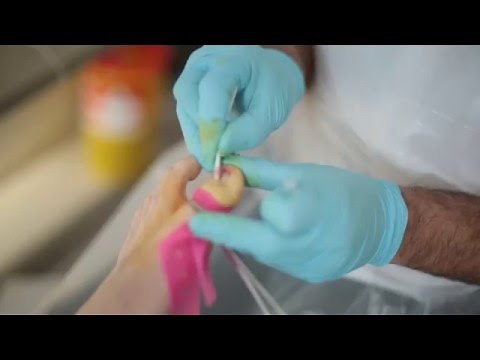 Ingrown toenail Surgery - Total Nail Avulsion