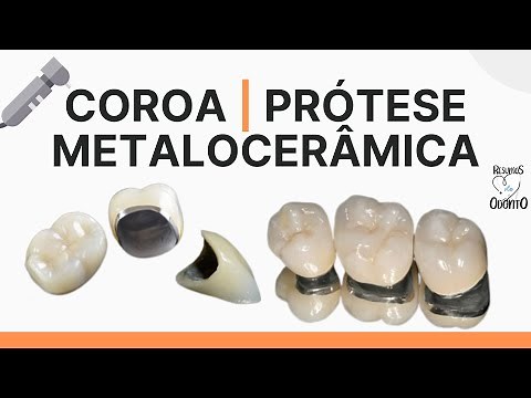 COROA METALOCERÂMICA | Resumos de Odonto