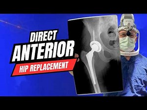 Hip Replacement Surgery Reimagined | Anterior Approach Technique