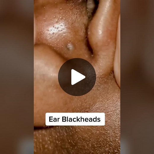 Ear Blackheads: Pimple Popping at Barber Shop | Episode 513