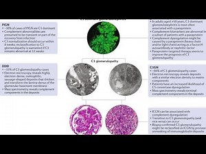 Organized Deposit and Non-organized Deposit Glomerulonephritis Disease