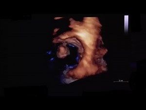 Left ventricular myxoma