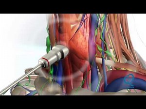 Tiroides - Información para pacientes