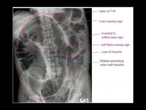 Coffee Bean Sign - Sigmoid volvulus - Radiology