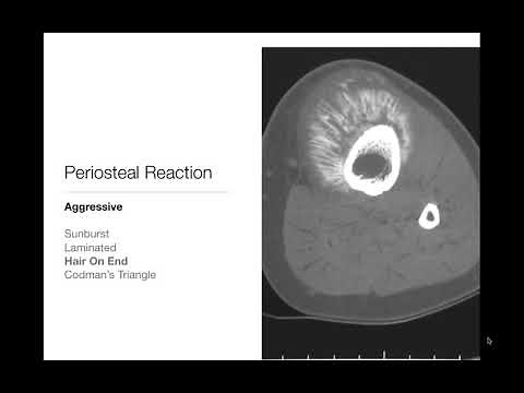 Bone Tumors - Periosteal Reaction - Radiology Basics
