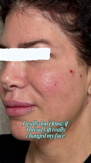 Thread Lift Before After Same Day Results #shorts