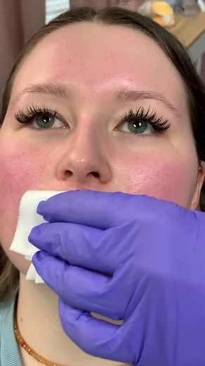 75K views · 1.4K reactions | Before/After Lip flip and lip filler- because we believe people should do what makes them feel beautiful ❤️ #lipfiller #lipfillerbeforeandafter #lipflip | Cook It Erica | Facebook