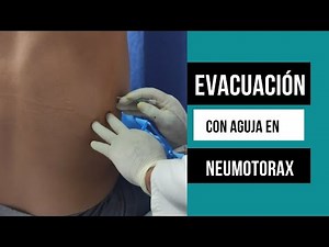 NEEDLE DECOMPRESSION IN PNEUMOTHORAX