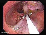 Colonoscopic Polypectomy (11 of 18) • Video • MEDtube.net