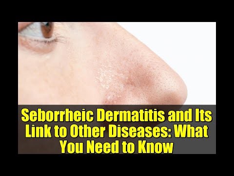 Seborrheic Dermatitis and Its Link to Other Diseases: What You Need to Know