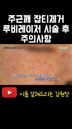Precautions After Ruby Laser Treatment for Freckles and Blemishes #RubyLaser #rubylaser #freckles...