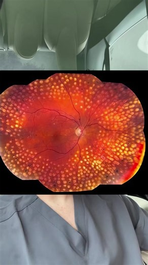 Let’s talk about the maintenance strategy for diabetic retinopathy #eyes #retina #diabetes #retinopathy #diabeticretinopathy