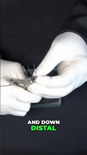 Orthodontics: Z-Band Root Distalization Technique Explained! #shorts