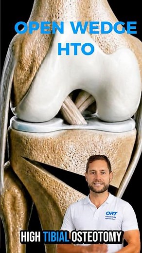 Open Wedge HTO: Realignment of the Arthritic Knee