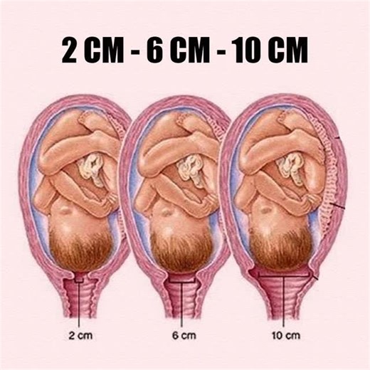 🌸 CERVICAL DILATION GUIDE 🌸 📏 2 CM – Early labor ⏳ Mild contractions, cervix starting to open. 📏 6 CM – Active labor 💓 Stronger contractions, baby moving down. 📏 10 CM – Fully dilated 👶 Ready for pushing, baby is about to be born! ✨ Each mama’s labor is unique — dilation progress varies. #LaborAndDelivery #Dilation #pregnancyjourney #MumworldIn #everythingaboutpregnancy | Mum_world_