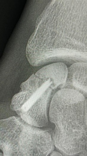 Tobias Ebster on Instagram: "❌Unfortunately my Dakar 2026 is over❌ I went down in a left corner at km 14 of Stage 3 and re-broke my scaphoid that was already fixed before. I tried to pick up the bike and continue, but i knew immideatly what happend It hurts a lot because I couldn’t show what we worked so hard for with the whole Hero Motorsports team and where we could have been. Thank you from the bottom of my heart to every single person in this team — your support means everything All your Mes