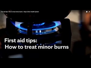 First aid tips: How to treat minor burns - Mayo Clinic Health System