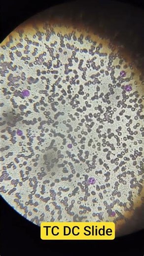 TLC Count in the Microscope, Total Leucocyte Count in Bangla (Slide Method) #cbctest #pbf #wbctest