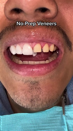 Transformative No-Prep Veneers for Small Teeth and Gaps