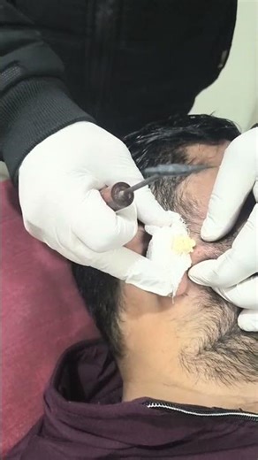 sebaceous cyst remove by agnikarma #minivlog #villagelife #comedy #minivlogtop #funny #ciby #julie