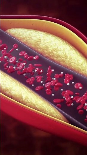 What are Clogged Arteries, Atherosclerosis