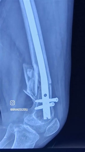 Closed Shattered distal femur #Managed with CLOSED REDUCTION AND INTERNAL FIXATION with DFN.