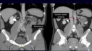 Robotic Salvage Pyeloplasty with Buccal Mucosal Onlay Graft A Simplified Technique