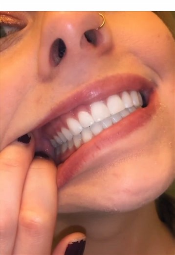 Understanding the 3 Types of Bites in Dentistry