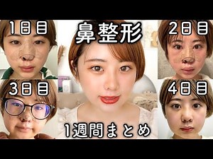 [Rhinoplasty] Downtime progress summary for one week🖤