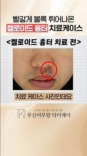 How to Treat Raised, Red 'Keloid Scars'!