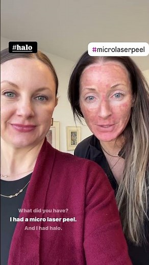 HALO vs. MicroLaser Peel 🔥✨ See the Difference! Who’s Healing Faster? 🤔 #Skincare #lasertreatment