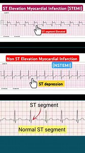 111K views · 1K reactions | #ECG STEMI Vs NSTEMI! | House of Medical Skills and Knowledge with Dr IsraelGi | Facebook
