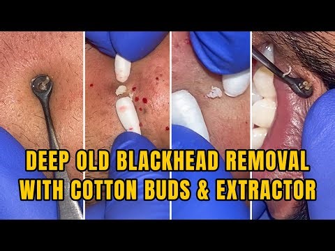 DEEP OLD BLACKHEAD REMOVAL WITH COTTON BUDS & EXTRACTOR | DR.LALIT KASANA |