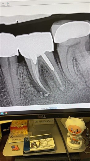 What’s your radiographic diagnosis? #dentists #dentalcare #dentalartistry #rootcanaltherapy