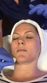 Perfect Derma Peel application