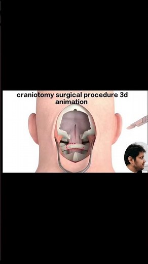 craniotomy surgical procedure || craniotomy surgical procedure 3d animation || cranial surgery