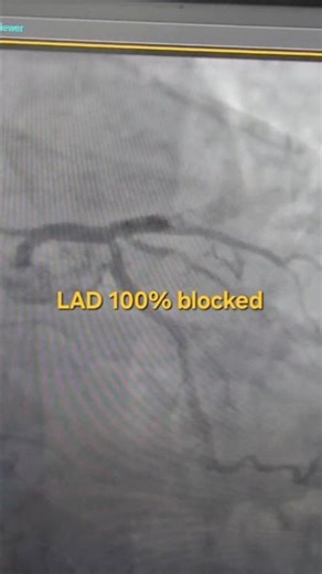 LAD Stenting #STEMI #stenting #drmanjeetcardiologist #acuteMI