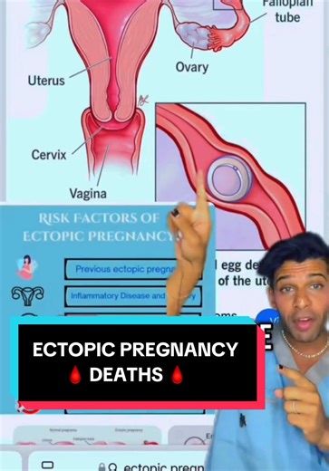 🗣️Your fallopian tube was never meant to carry a pregnancy! Ruptured ectopic pregnancy explained 👊🏽 #forensicpathologist #dryaseenbismilla #forensicpatholgy #onthisday
