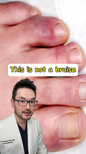 Understanding Chillblains: Causes, Symptoms, and Treatment